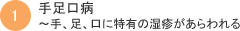 手足口病～手、足、口に特有の湿疹があらわれる